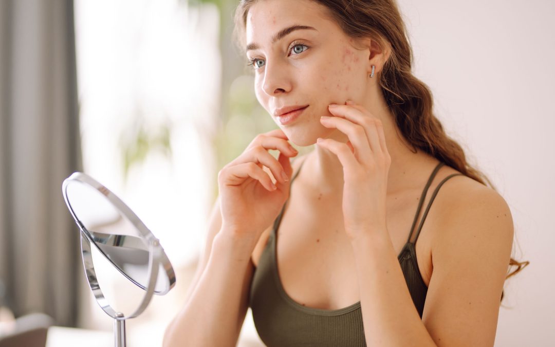 Vaincre l’acné rosacée avec des traitements naturels : solutions douces et efficaces