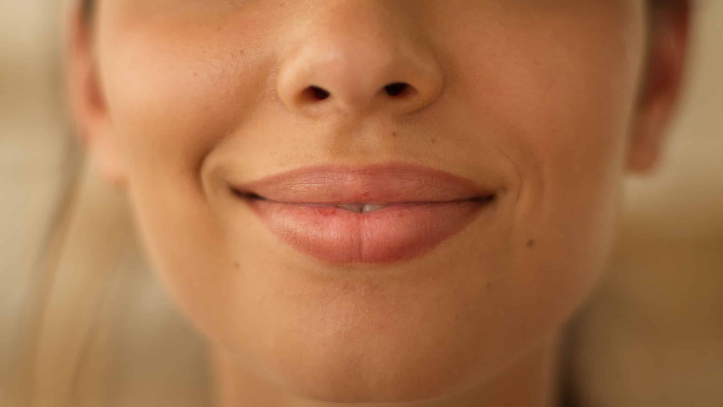 Guérir l’herpès labial avec des traitements naturels Guérir l'herpès labial avec des traitements naturels